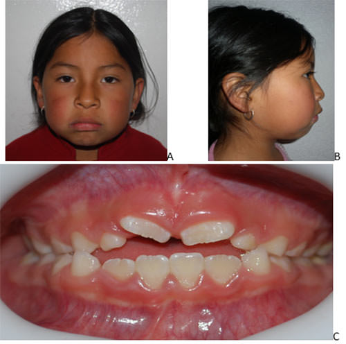Fig. 1. A y B Fotografías extraorales donde se observa retrusion del mentón, biprotrusión y perfil convexo. C. Imagen intraoral que muestra la mordida abierta anterior y cruzada posterior del lado izquierdo.