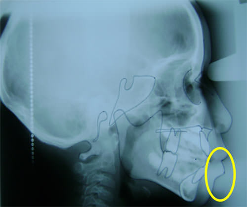 Fig. 2 Radiografía lateral del cráneo donde se observa la hiperdivergencia y la mordida abierta anterior, obteniéndose mediante el trazo cefalométrico una base anterior corta y maxilar aumentado, cuerpo mandibular disminuido, protrusión maxilar y ligera retrusión mandibular, con rotación de bases craneal.