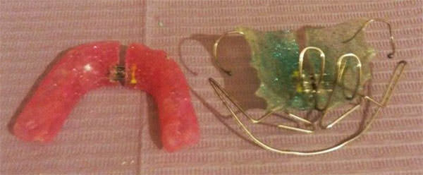 Fig. 3 Características del aparato inferior son: caras oclusales cubiertas con acrílico para intrusión molar para cierre de mordida y tornillo de expansión estándar. El aparato superior presenta un arco vestibular que permite la retrusión y descenso premaxilar, tornillo estándar y aditamentos elaborados con barra de metal redondeados a la altura de caninos en palatino para control de deglución atípica.