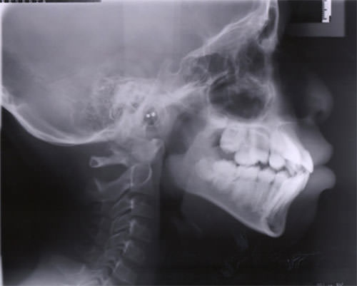 Figura 1 Radiografía Cefálica Lateral de inicio