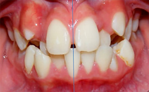 Figura 5 Intraoral de frente