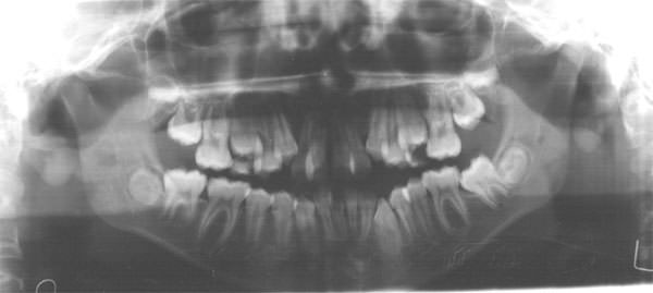 Figura 9 Radiografía Panorámica de inicio