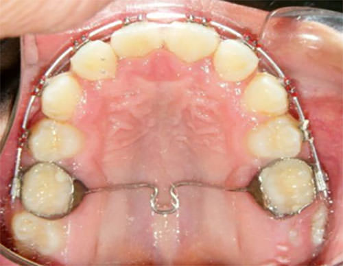 Figura 10 Oclusal Superior