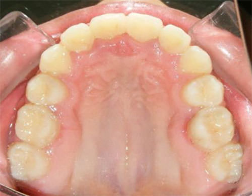 Figura 12 Oclusal Superior