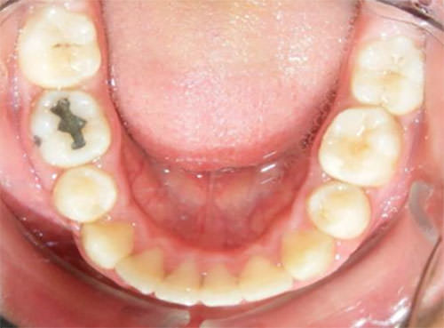 Figura 13 Oclusal Inferior
