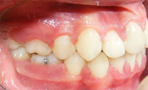 Figura14 Lateral derecha