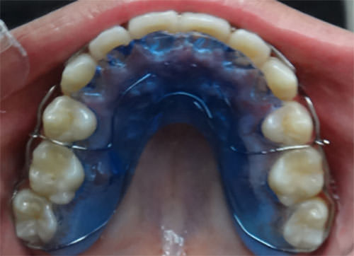 Figura 20 Vista oclusal retenedor superior