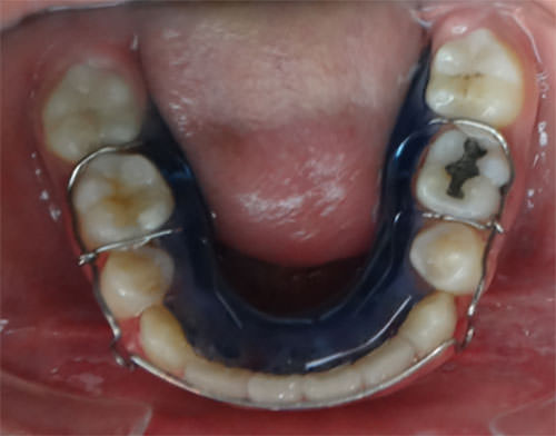 Figura 2 Oclusal retenedor inferior