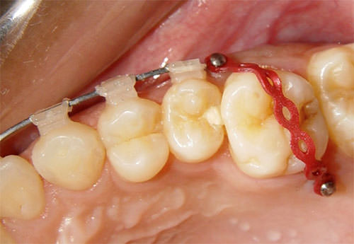 Imagen 8 Intrusión del molar con mini - implante y cadena elástica30