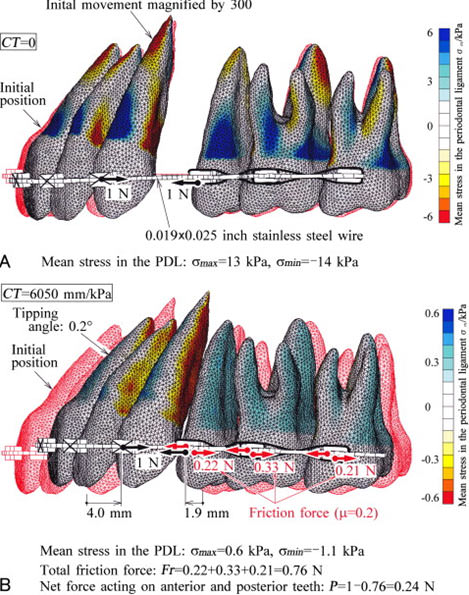 Fig. 2 Numeric simulations of en-masse space closure with sliding mechanics. AJODO, 2010
