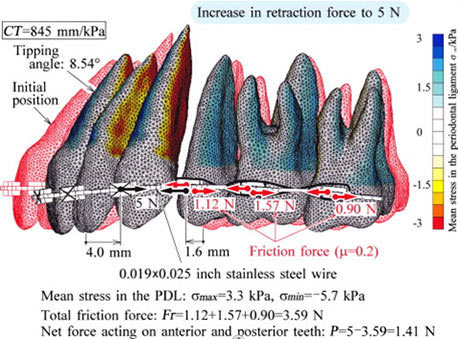 Fig. 3 Numeric simulations of en-masse space closure with sliding mechanics. AJODO, 2010