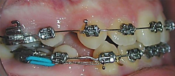 Fig. 4 The effectiveness of laceback ligatures: a randomized controlled clinical trial. Journal Orthodontics. 2004