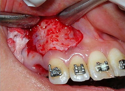 Fig. 7 Miniscrew implant-supported maxillary canine retraction with and without corticotomy-facilitated orthodontics. AJODO 2014