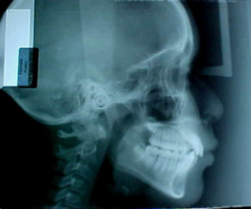 Figura 8 radiografía lateral de cráneo inicio