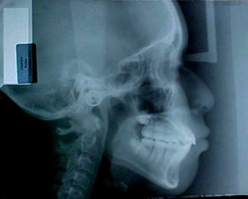 Figura 23 radiografía lateral de cráneo