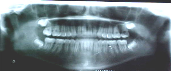 Figura 24 radiografía panorámica
