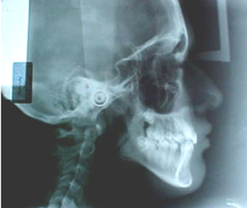 Fig. 9 Radiografía lateral de cráneo