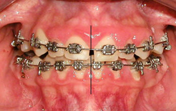 Fig.14 Fotografía intraoral de frente