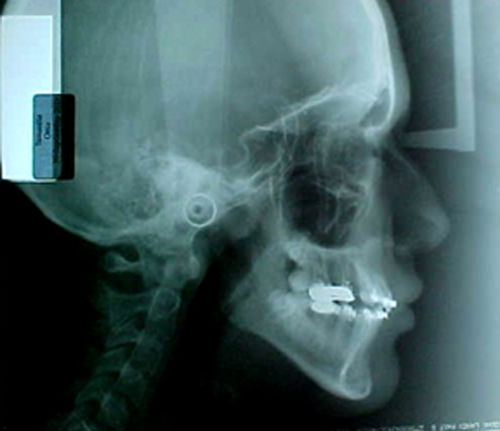 Fig. 19 Radiografía lateral de cráneo
