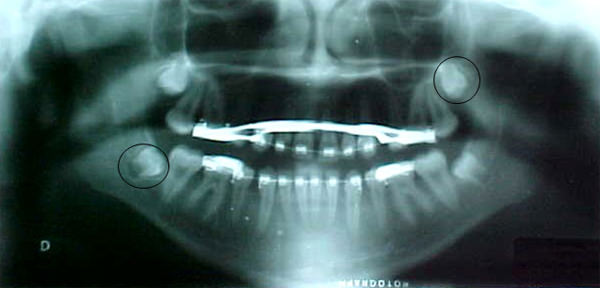 Fig 20. Radiografía panorámica