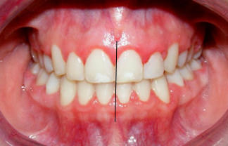 Fig. 24 Fotografía intraoral de frente