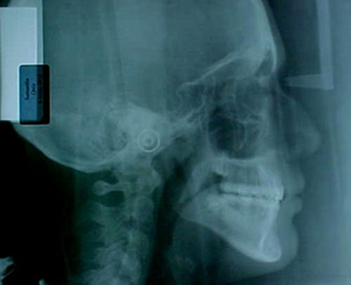 Fig. 29 Radiografía lateral de cráneo