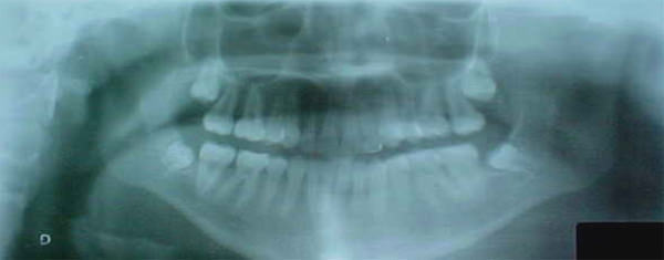Fig. 30 Radiografía panorámica