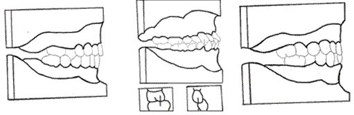 Figura Nº 5 Clase I tipo 5
