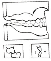 Figura Nº 8 Clase III Tipo 1