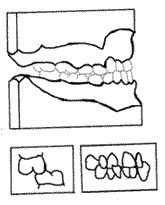 Figura Nº 9 Clase III tipo 2
