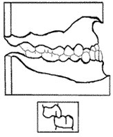 Figura Nº 10 Clase III tipo 3