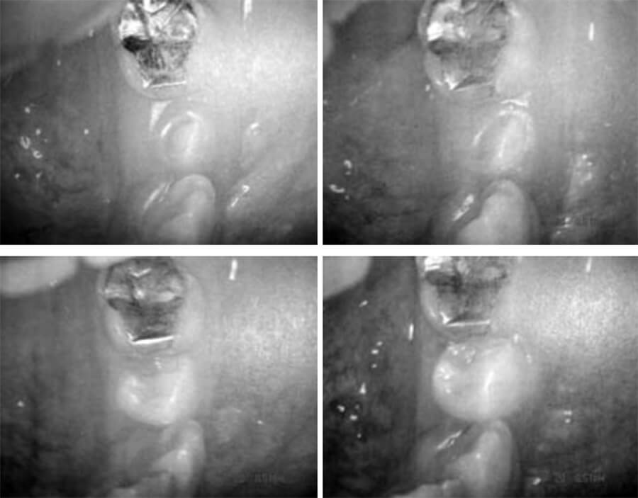 Figura 2. Emergencia y secuencia de erupción en primer premolar.