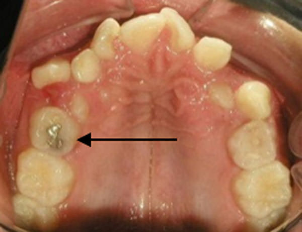 Figura 1 Oclusal superior