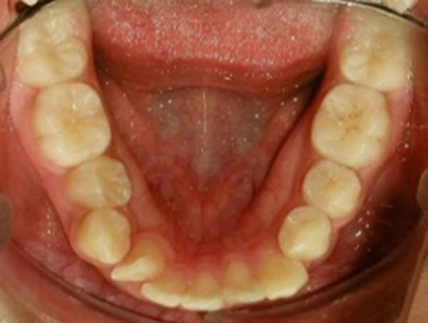 Figura 2 Oclusal inferior