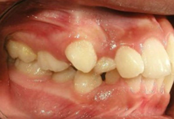 Figuras 4 Intraoral lateral derecha