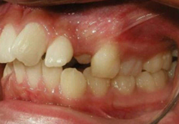 Figuras 4a Intraoral lateral izquierda