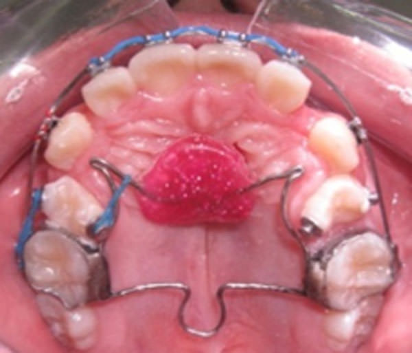 Figura 9 Fotografía oclusal en estudios progreso