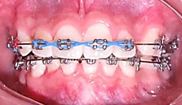 Figura 10 Fotografía intraoral de frente