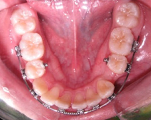 figura 11 Oclusal inferior