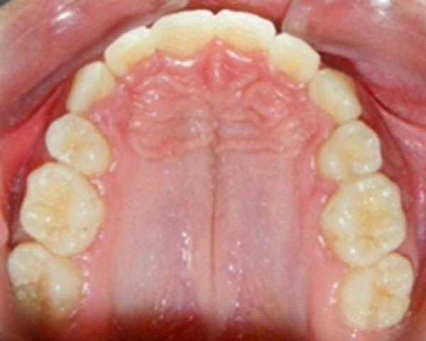 Figura 16 Oclusal superior