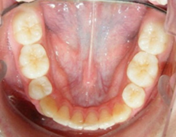 Figura 17 Oclusal inferior