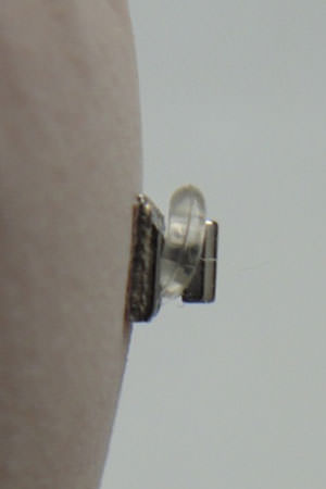 Figure 3 Elastomeric ring engaged onto the modified bracket, ehich other wise accepts only a lock pin or a wire ligature tie.