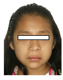 Fig. 1 Extraoral de frente inicial