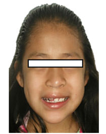 Fig. 3 De sonrisa