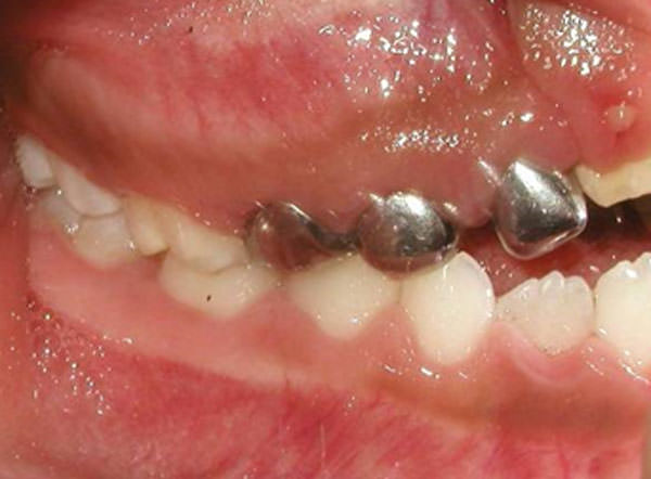 Fig. 5 Intraoral lateral derecha