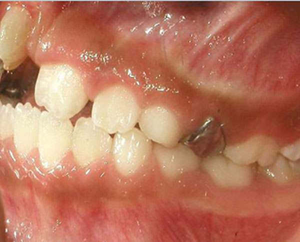 Fig. 6 Lateral izquierda
