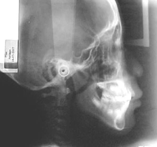 Figura 9 Radiografia cefálica lateral