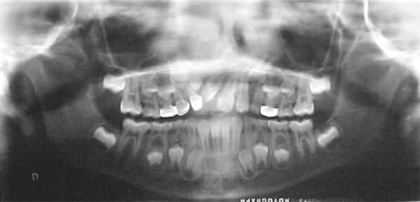 Fig.10 Radiografía panorámica tomada a los 8 años 9 meses de edad 