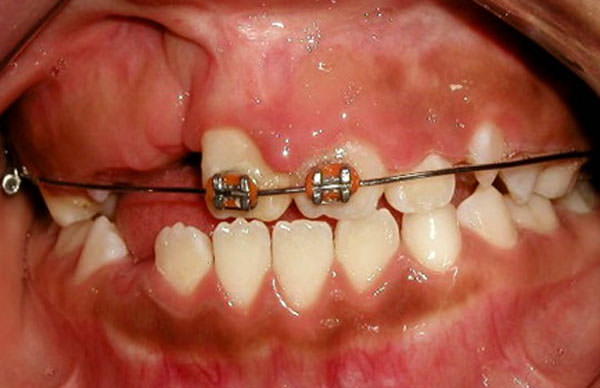 Fig 11 b intraoral frente con braquetes