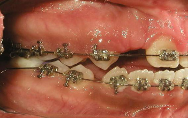 Fig. 13 Lateral derecha